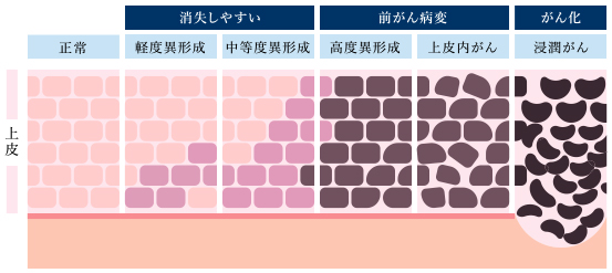 子宮頸がんとは？