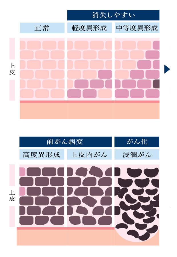 子宮頸がんとは？